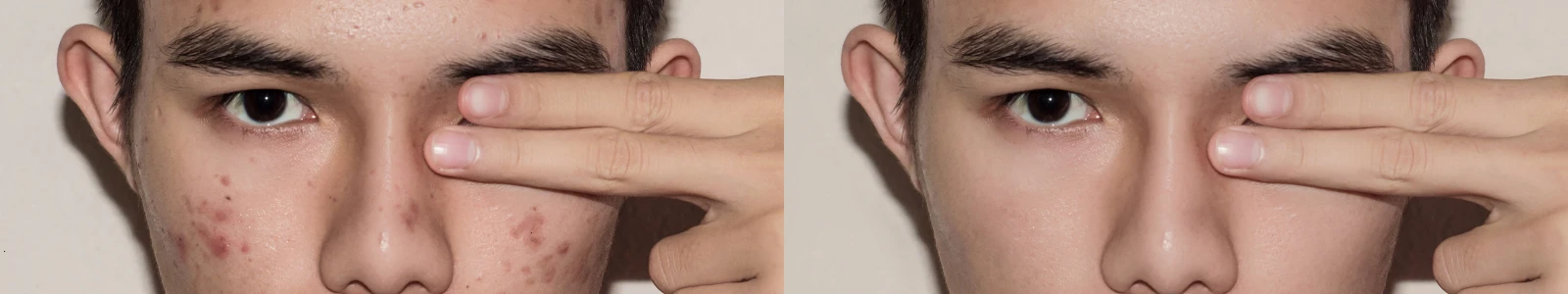 Adult Acne Treatment UK: Why Am I Still Getting Acne and What Actually Works?