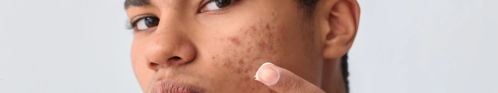 Acne, Rosacea or Eczema? How to Tell the Difference and When to Get Treatment
