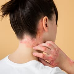 Psoriasis category