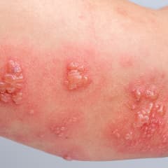 Skin Infections category